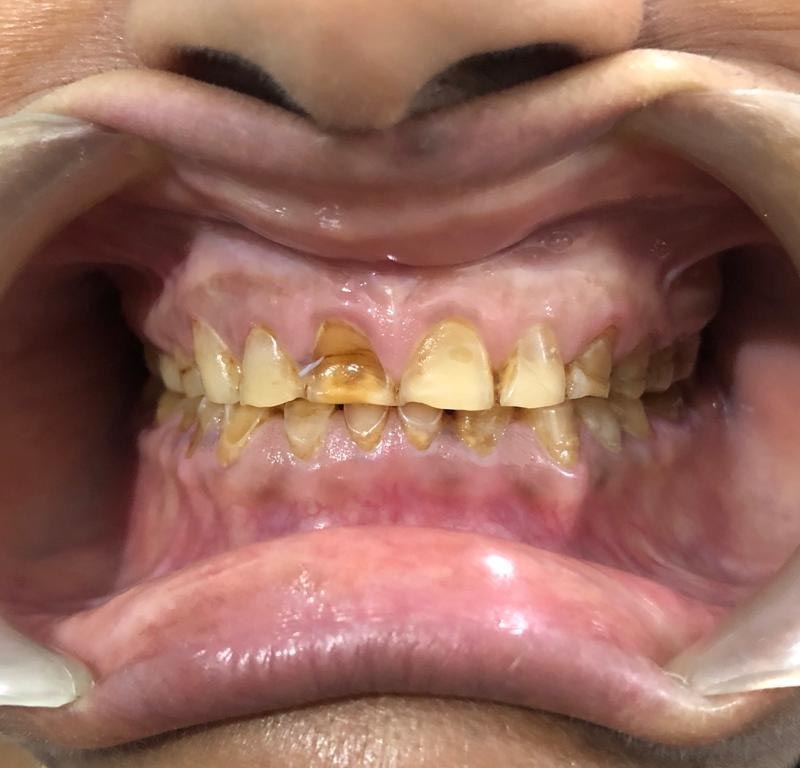 dental implant in Patna