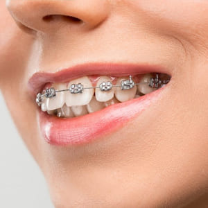 Best dental clinic in Patna for Braces